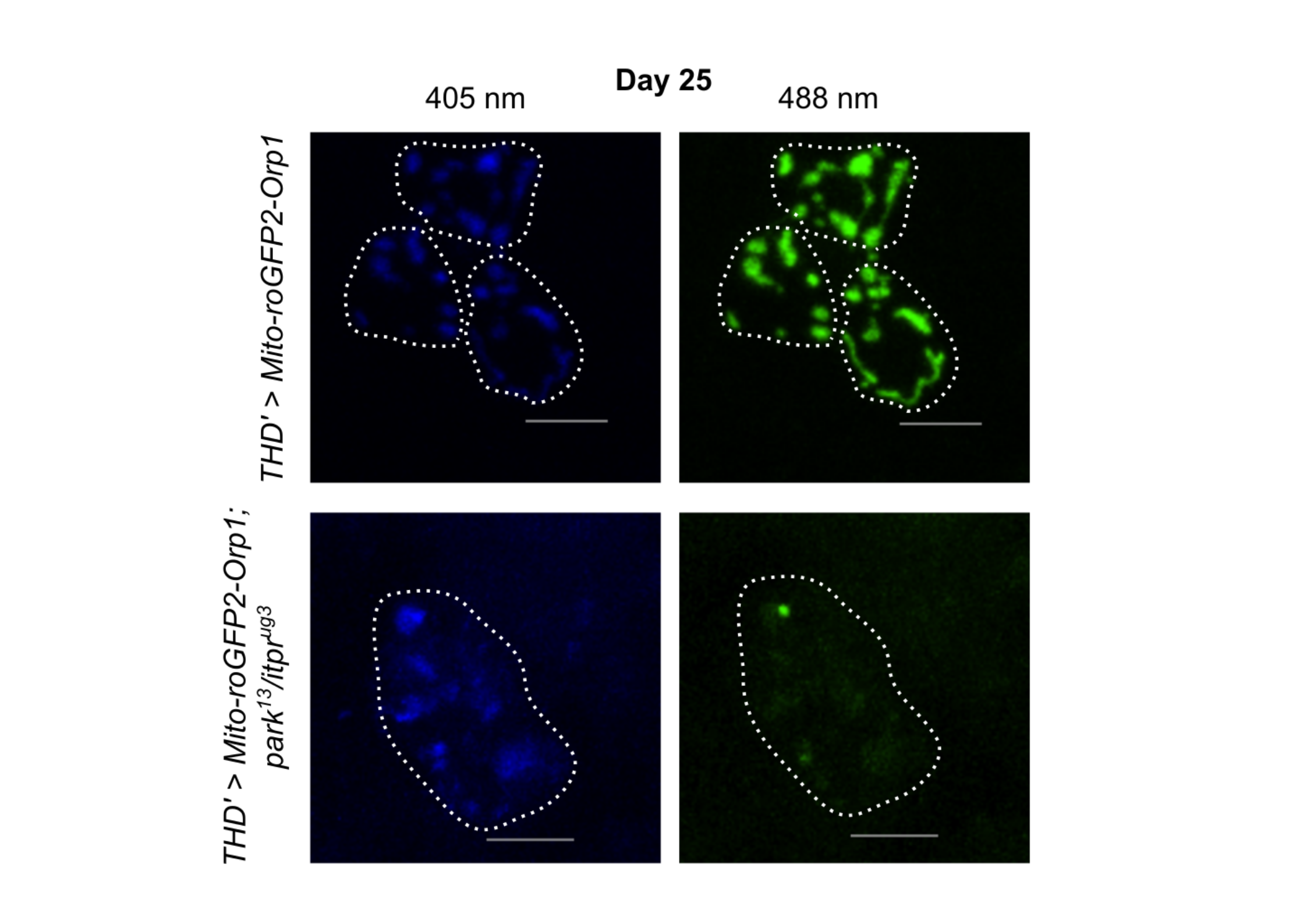 When two molecular glitches push neurons toward Parkinson’s