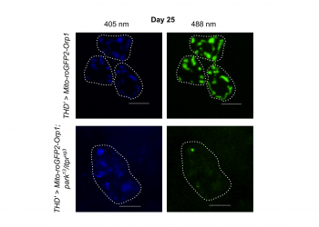 When two molecular glitches push neurons toward Parkinson’s