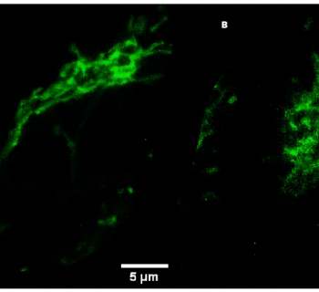 Clues about Lowe Syndrome from the cell's powerhouses