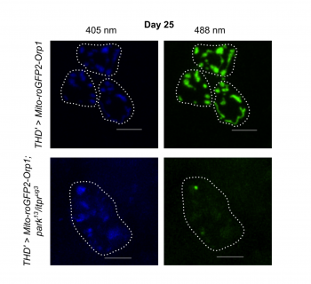 When two molecular glitches push neurons toward Parkinson’s
