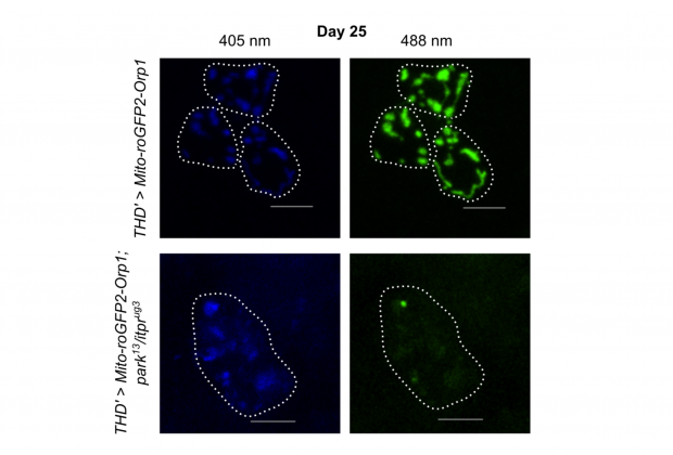 When two molecular glitches push neurons toward Parkinson’s